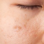 毛穴洗浄の効果は？エステでは超音波で汚れ除去！